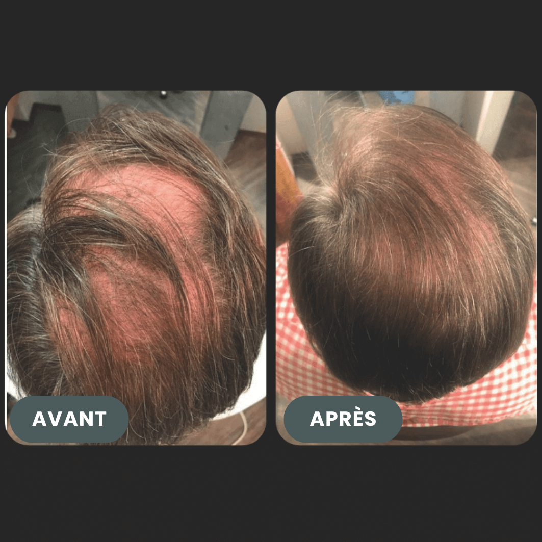 Folixir - Votre allié contre la perte de cheveux