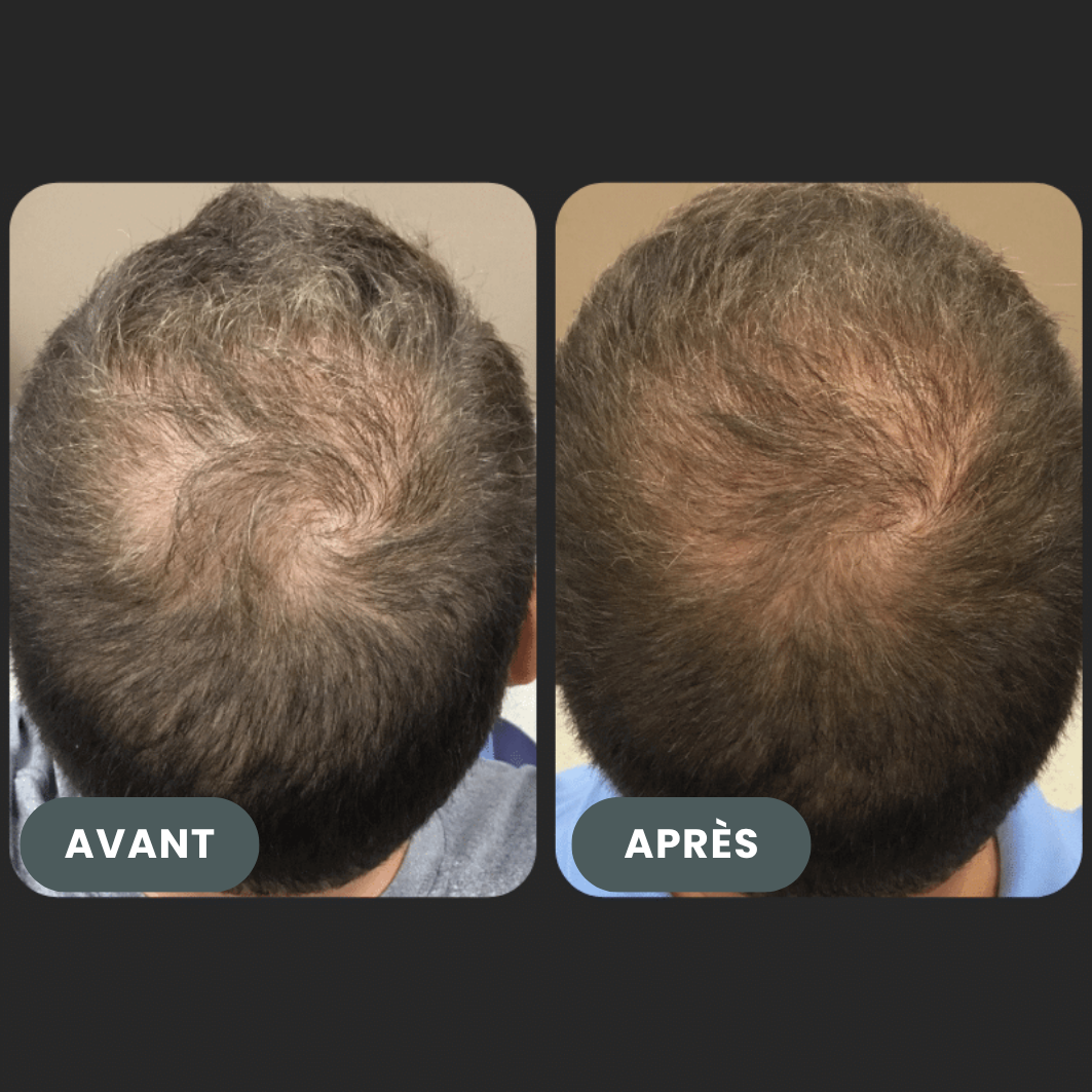 Folixir - Votre allié contre la perte de cheveux