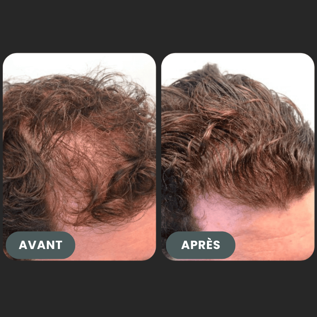 Folixir - Votre allié contre la perte de cheveux
