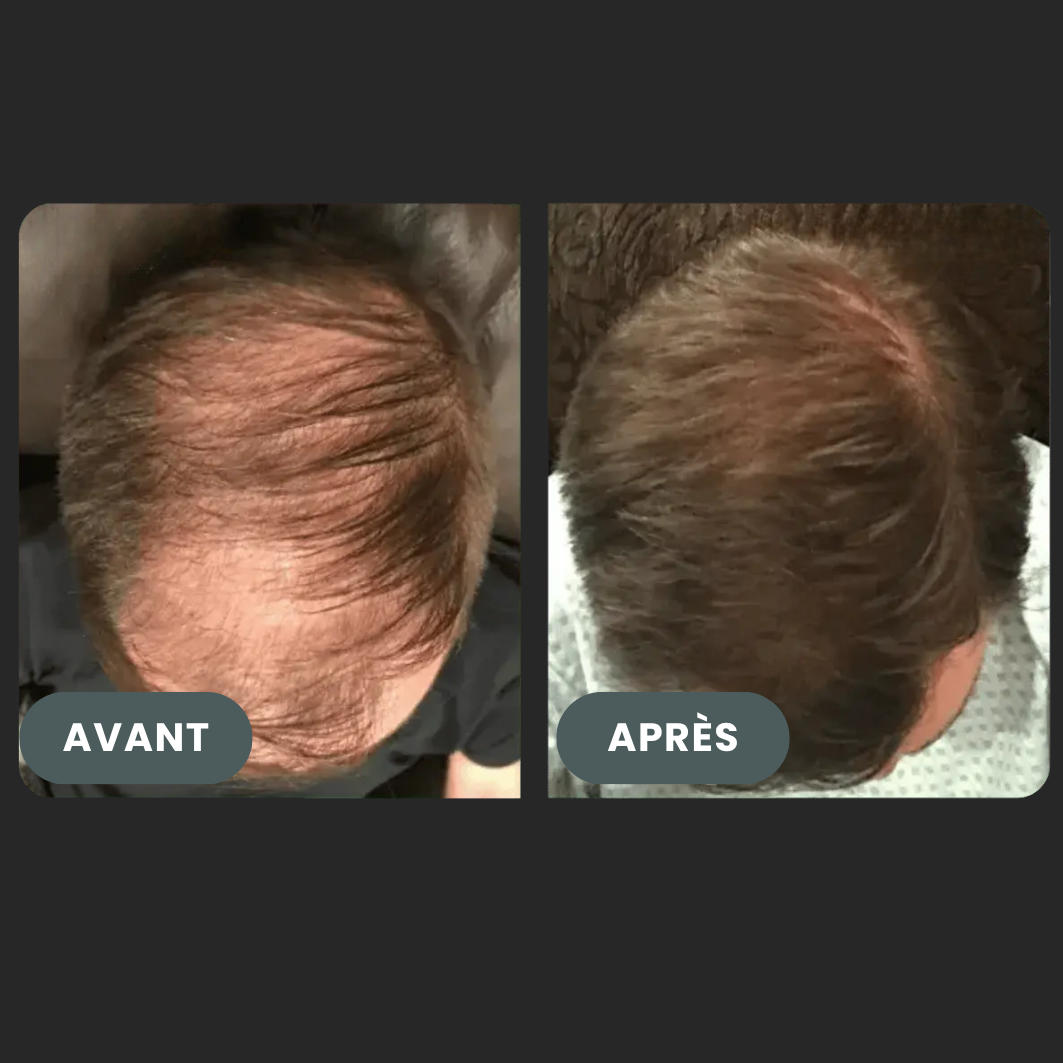 Folixir - Votre allié contre la perte de cheveux