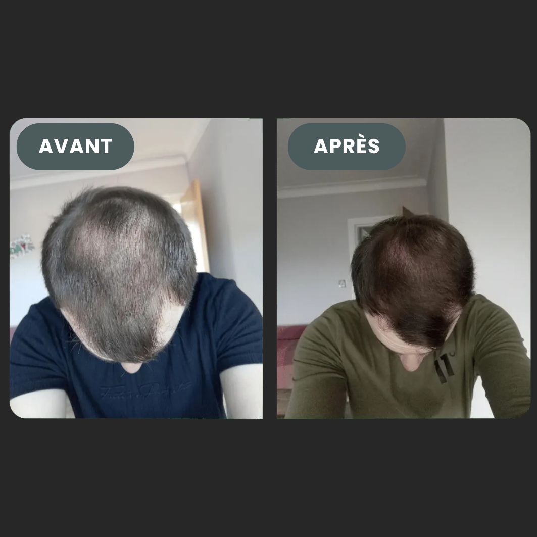 Folixir - Votre allié contre la perte de cheveux