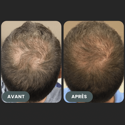 Folixir - Votre allié contre la perte de cheveux