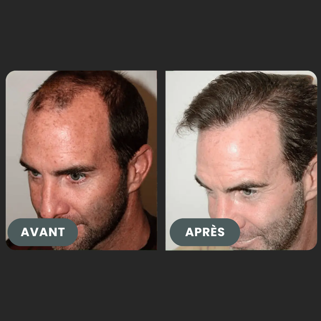 Folixir - Votre allié contre la perte de cheveux
